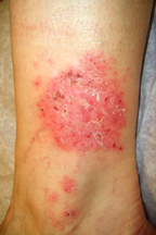 dry skin rash